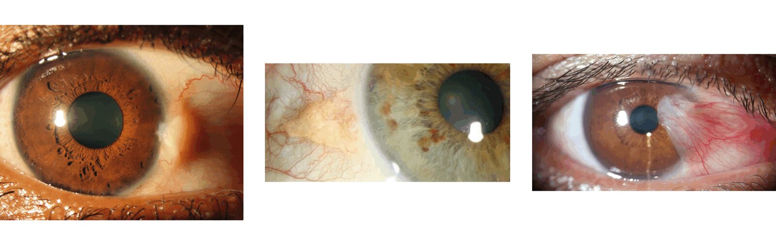 photo - pterygium